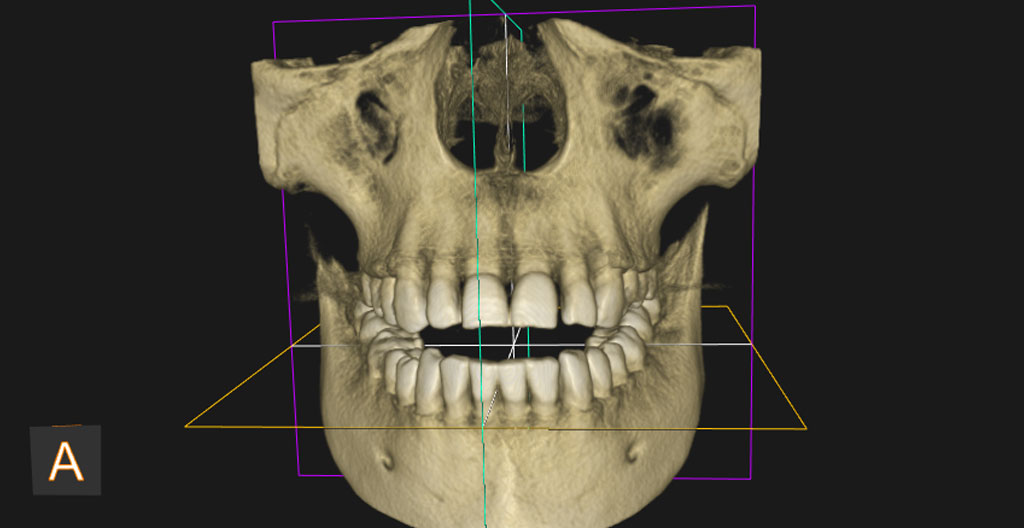снимок перед имплантацией зубов