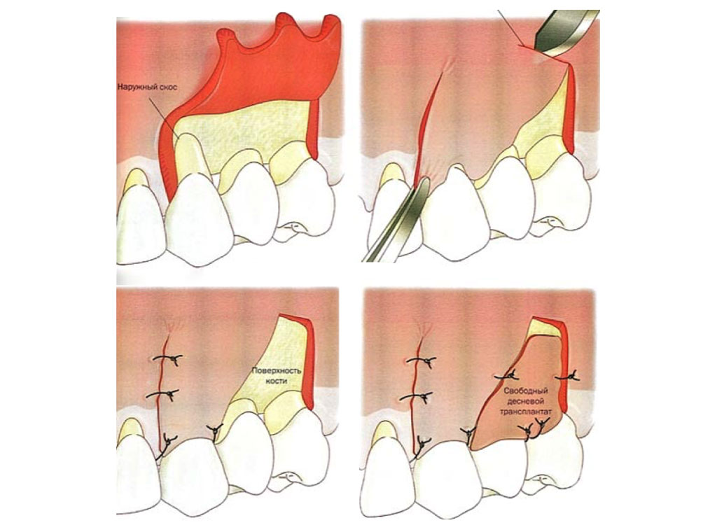 Хирургические вмешательства: пластика десны и другие методы восстановления здоровья зубов