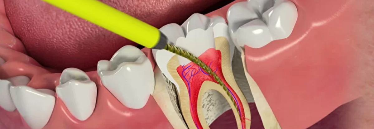 лечение каналов зуба в стоматологии