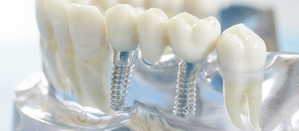 стоматологическая клиника имплантация зубов
