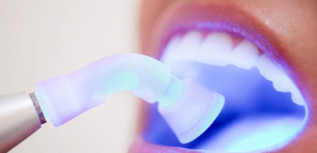 стоматологическое отбеливание зубов