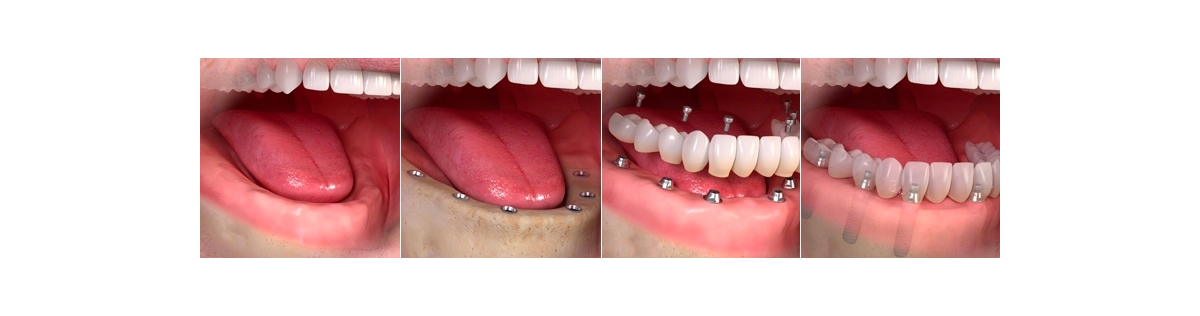этапы полной имплантации зубов