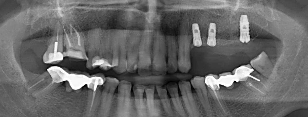 снимок перед имплантацией верхних зубов