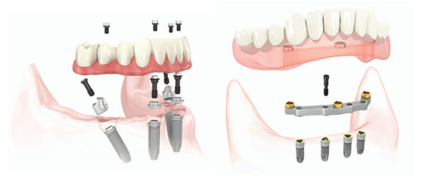 имплантация зубов all on 4